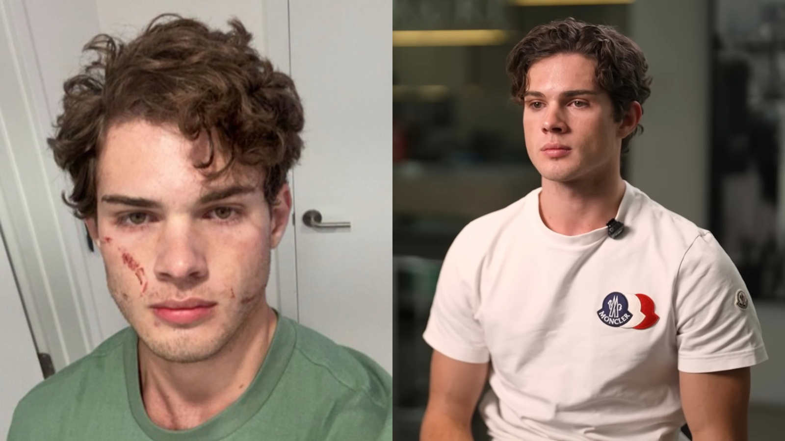 Clavicular overdose symptoms